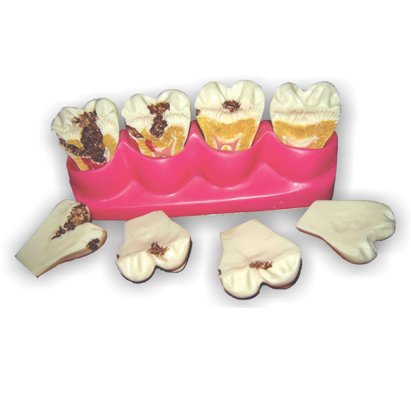 Evolucion de caries